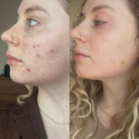 AO2 Clear - Acne Clearing - 30 Day Kit before and after showing improvements in acne on facial skin.